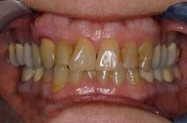 Dull coloring and misshapen teeth
