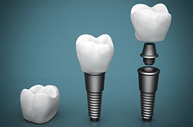 Diagram of the parts of a dental implant in Torrington