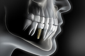 X-ray diagram of dental implants in Torrington