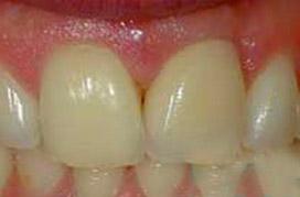 Smile with implant supported dental crown
