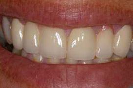 Perfectly repaired healthy smile