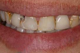 Discolored and decayed top teeth