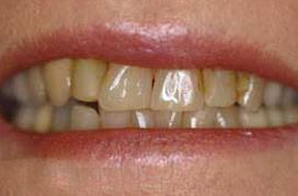 Yellowed teeth