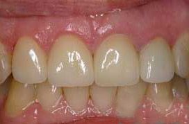 Discolored teeth repaired with flawless crowns