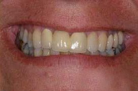 Flawless smile with a fixed bridge and porcelain veneers