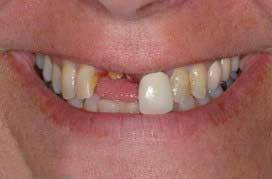 Chipped and damaged front teeth
