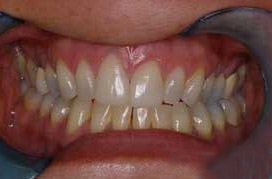 Perfected smile with porcelain veneers