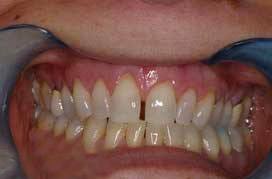 Gap in front teeth