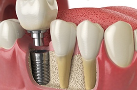 Illustration of implant that is integrated with surrounding tissue