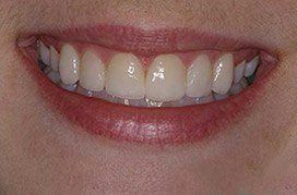 Flawless smile after porcelain veneer placement
