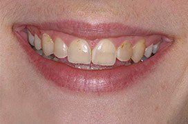 Smile with dental wear and discoloration
