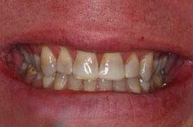 Severe dental staining and uneven tooth size
