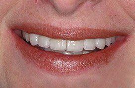 Gorgeous smile after ten porcelain veneers are placed