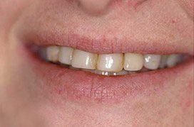 Dull and worn smile before treatment