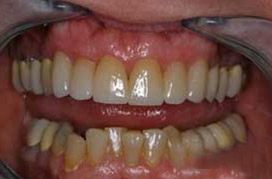 Beautiful look after six veneers are placed