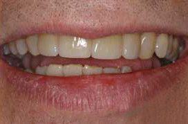 Perfectly aligned teeth with porcelain veneers instant orthodontics