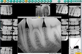 Dexis digital x-rays