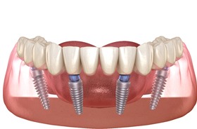 Illustration of All-on-4 dental implants and accompanying denture