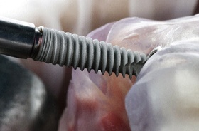 Close-up of dental implant being inserted into jawbone model