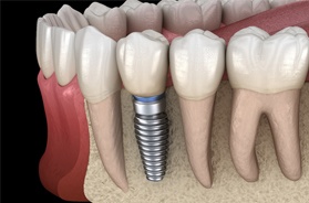 dental implant and surrounding bone