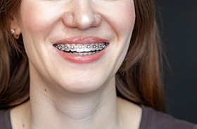 Close-up of woman’s smile with traditional metal braces