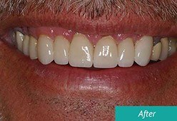 David's smile after treatment