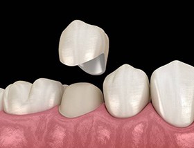 dental crown illustration