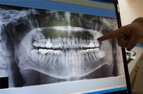 Dental x-rays on computer screen