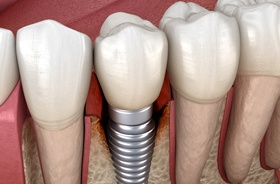 Illustration of peri-implantitis, a common cause of dental implant failure