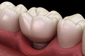 Illustration of gums receding around a dental implant
