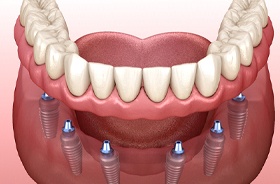 Illustration of implant dentures in Torrington for lower arch