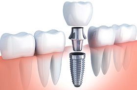Illustration of single dental implant, abutment, and crown