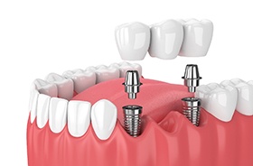 Illustration of 3-unit dental implant bridge for lower arch