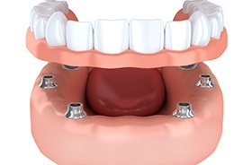 Illustration of implant denture being placed on four dental implants