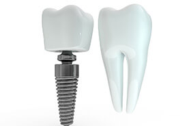 Dental implant in Torrington next to model tooth