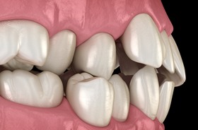 close-up illustration of badly misaligned teeth