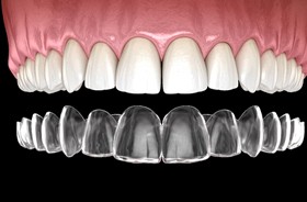 Illustration of clear aligner being used to shift teeth