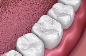 Animation of tooth-colored filling placement