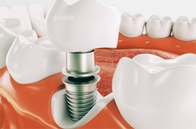 single dental implant illustration