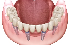 all-on-4 implants