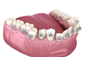 Illustration of traditional braces on bottom row of teeth