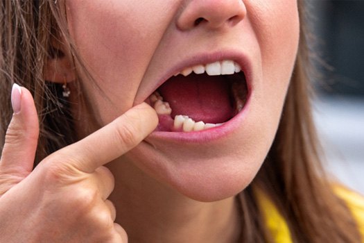Closeup of a missing tooth