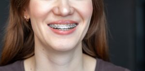 Close-up of woman’s smile with traditional braces in Torrington