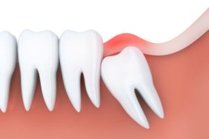 Illustration of fully impacted wisdom tooth